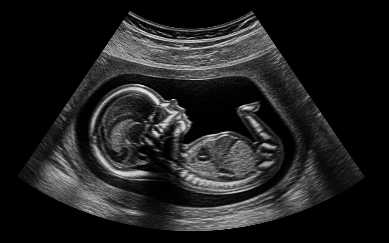 Zwart-wit 2D echobeeld van een baby in profiel